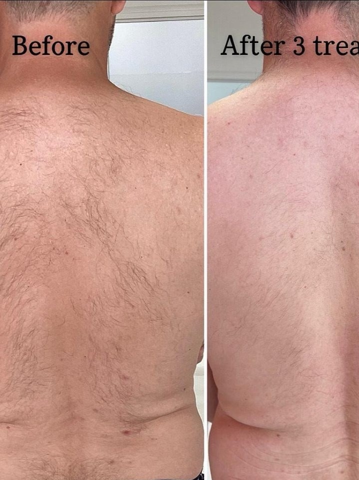 Rug voor en na drie laserbehandelingen
